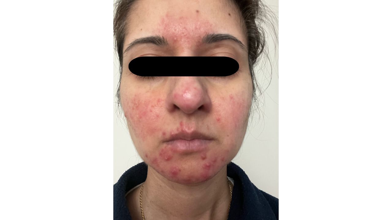 rosacea picture of me
